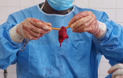INTERVENTION RÉUSSIE D’UN CANCER DE LA PROSTATE LOCALISÉ, HIER MERCREDI 9 MARS 2022 À L’HÔPITAL NATIONAL AMIROU BOUBACAR DIALLO 
